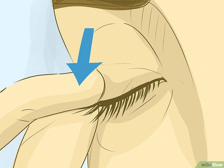 Cách lấy mạt sắt trong mắt an toàn 